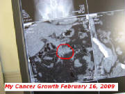 my-cancer-growth-feb-16-2009.jpg