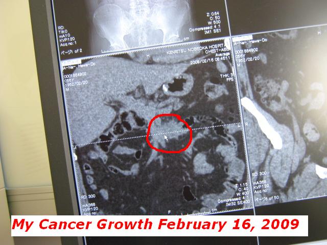 my-cancer-growth-feb-16-2009.jpg